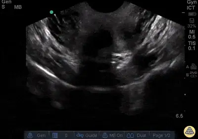 Bicornuate Uterus with IUP