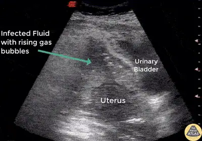 Uterine Perforation