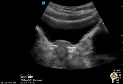 Transabdominal Uterus Transverse