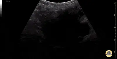 Uterus with Leiomyomas (fibroids)